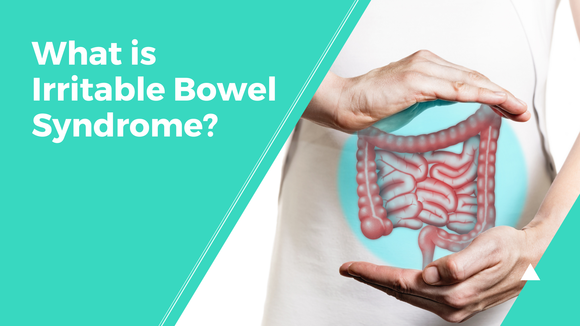 What is Irritable Bowel Syndrome?